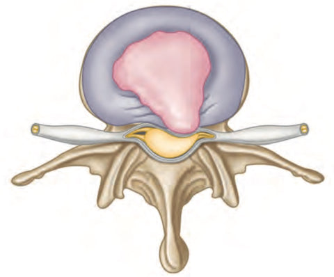 Trigger Point Therapy - Herniated Disc