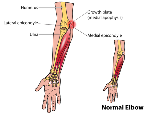 Little League Elbow Trigger Points