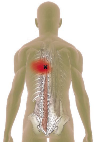 Multifidi Trigger Points - Referred Pain Patterns