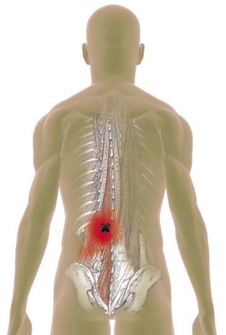 Multifidi Trigger Points - Referred Pain Patterns