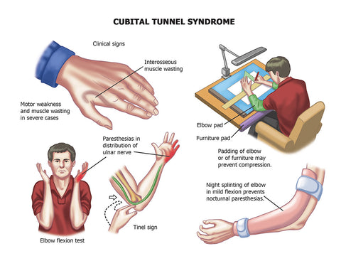 Cubital Tunnel Syndrome Symptoms Treatment