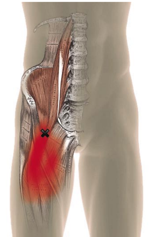 Psoas Trigger Point Pain Referral