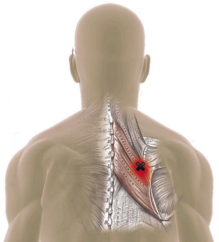 Rhomboid Muscles Trigger Points