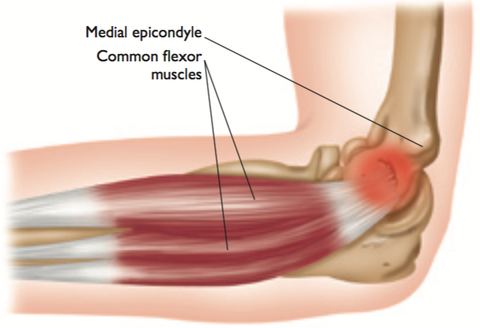 Golfer's Elbow Trigger Point Therapy