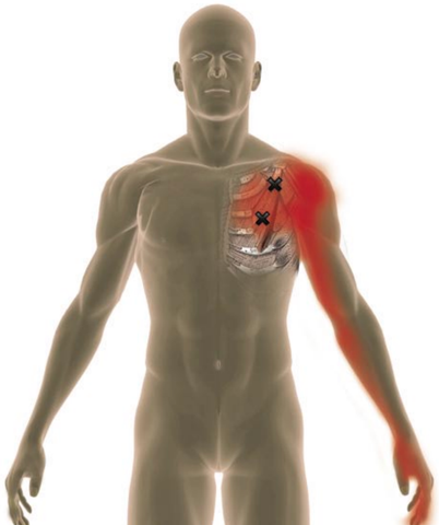 Pec Minor Trigger Points