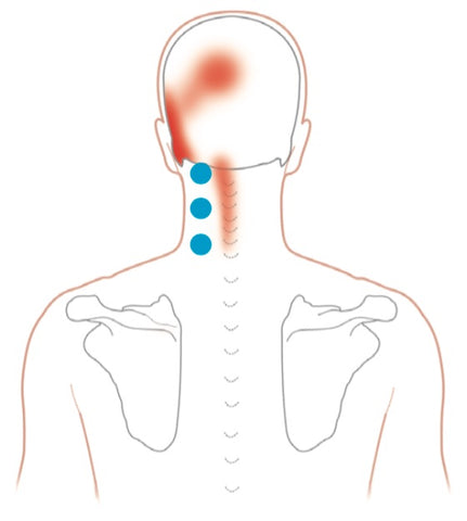 Longissimus capitis Trigger Points Pain Map