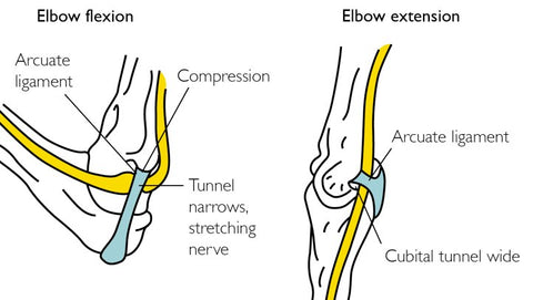 Cubital Tunnel Syndrome Trigger Points