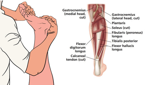 Treating Plantar Fasciitis Trigger Points