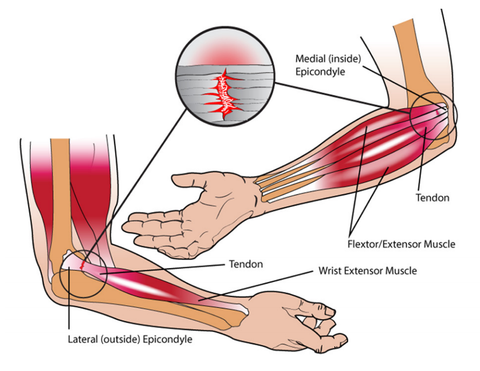 Lateral and Medial Elbow Inuries