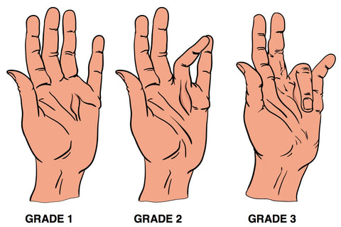 Dupuytren’s Contracture Trigger Points