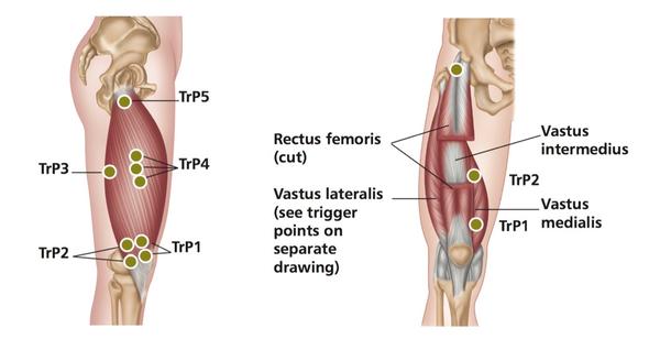 Quadriceps - Trigger Point Therapy Treatment Sites