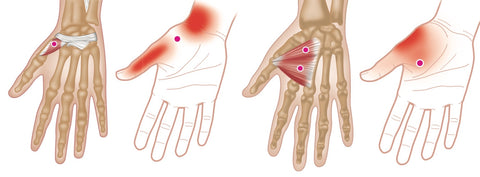 Hand and Wrist Trigger Points