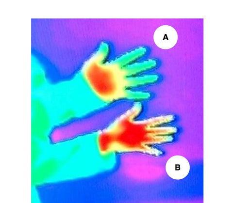 Reynaud's Syndrome Trigger Points