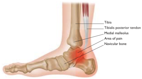Ankle Injuries
