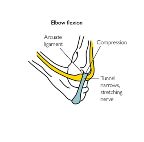 Cubital Tunnel Syndrome Trigger Point Therapy