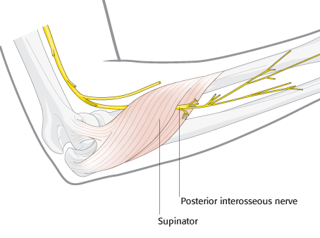 Peripheral Nerve Entrapments Trigger Points
