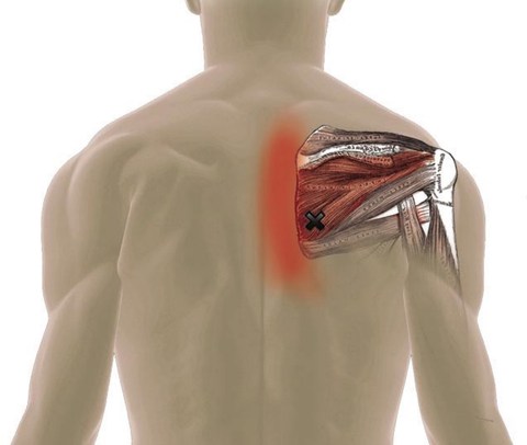 Infraspinatus Trigger Point