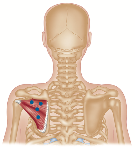 Infraspinatus Trigger Points