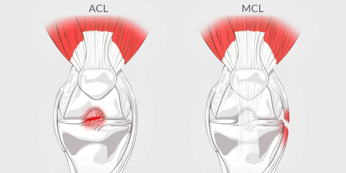 ACL MCL illustration