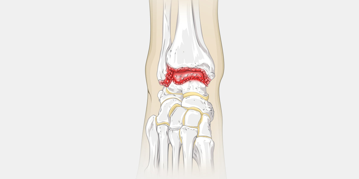 Ankle Arthritis Illustration
