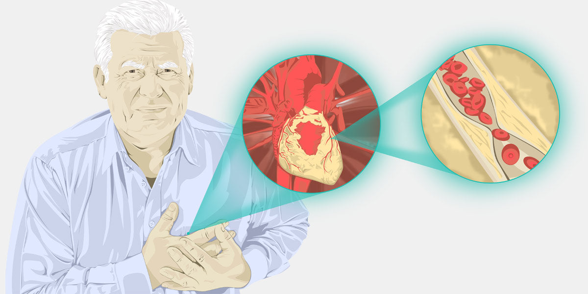Man with Heart Attack Illustration