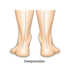 overpronation