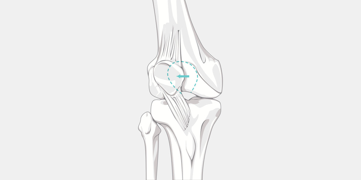 Patellar Dislocation Illustration