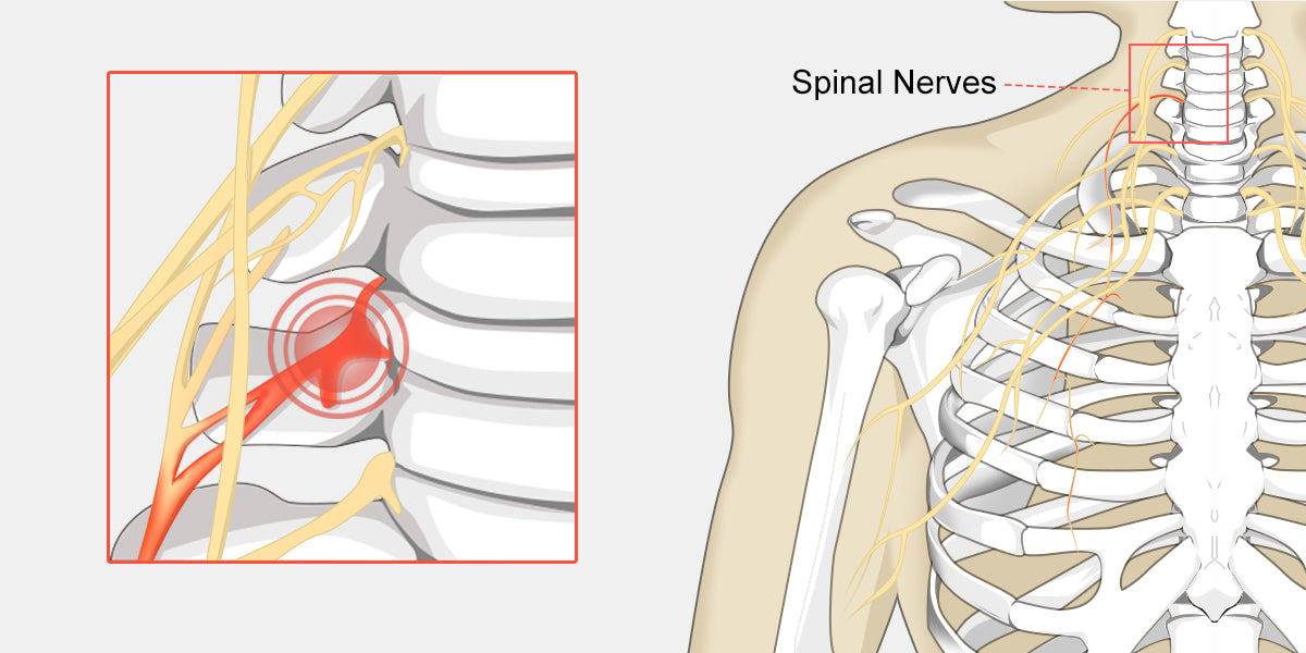 Pinched-Nerve-Diagram