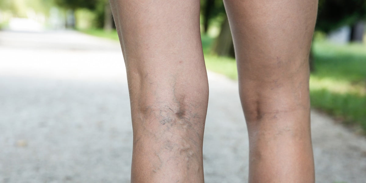 Varicose Veins