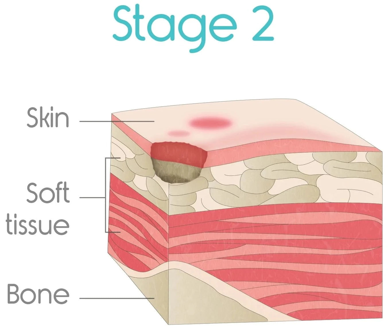stage two bed sores