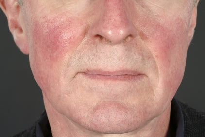 rosacea treatment. facial redness