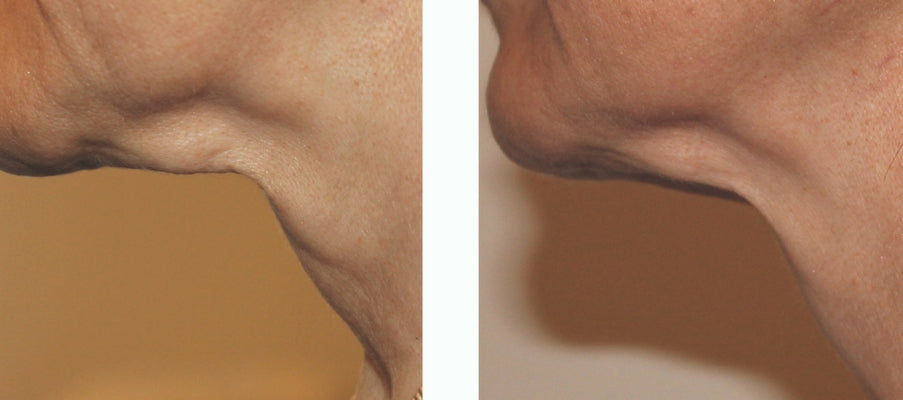 non surgical facelift. skin tightening for face and jawline victoria bc, butt lift