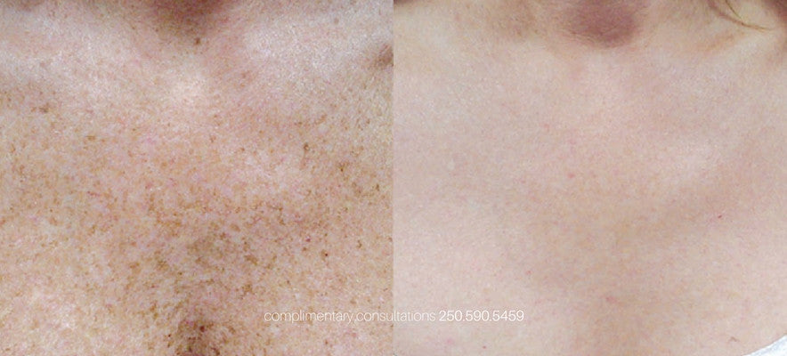 pigmentation treatment victoria bc. photofacial, brown spots, age spots, sun spots.