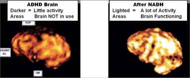 Brain scans of a ADHD brain before / after NADH