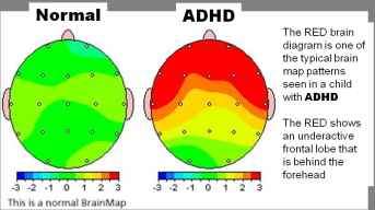 Before NADH / After NADH view of the brain activity