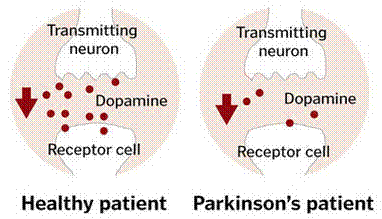 Parkinson's Sufferers NEED MORE Dopamine