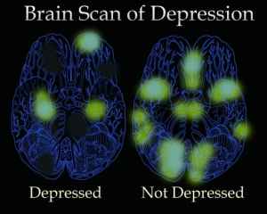 Brain activity changes for the better with NADH