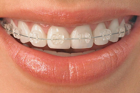 Orthodontic options for adults in 2018 | Northenden Orthodontics