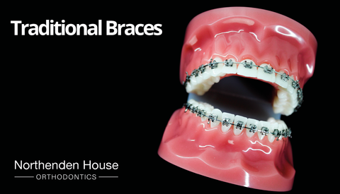 Metal braces