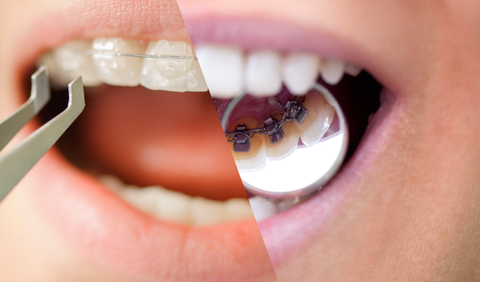 Lingual braces vs Ceramic braces