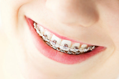 Long Term Benefits At An Early Age | Northenden Orthodontics
