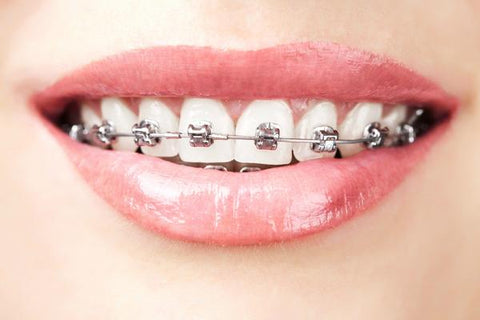 fixed braces | Manchester Orthodontics