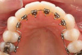 teeth straightening treatments