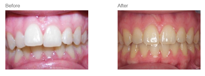 What results to expect from orthodontic treatment