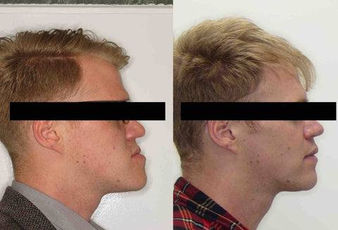 Jaw Surgery Recovery | Manchester Orthodontics 