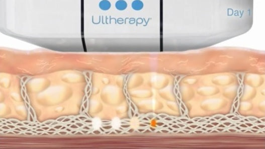 Ultherapy Skin Treatment Diagram