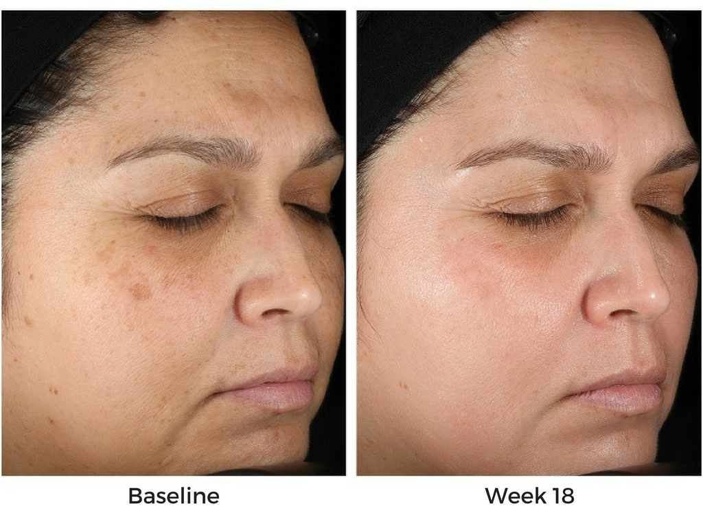 Obagi Nu-Derm Before and After