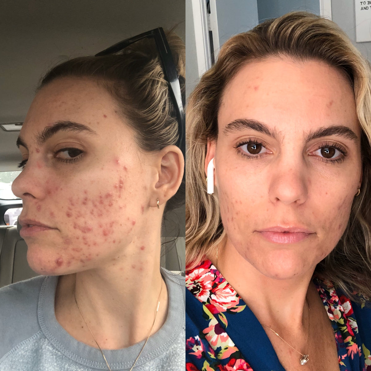 how-i-got-rid-of-my-cystic-acne-without-rx-my-pink-hanger