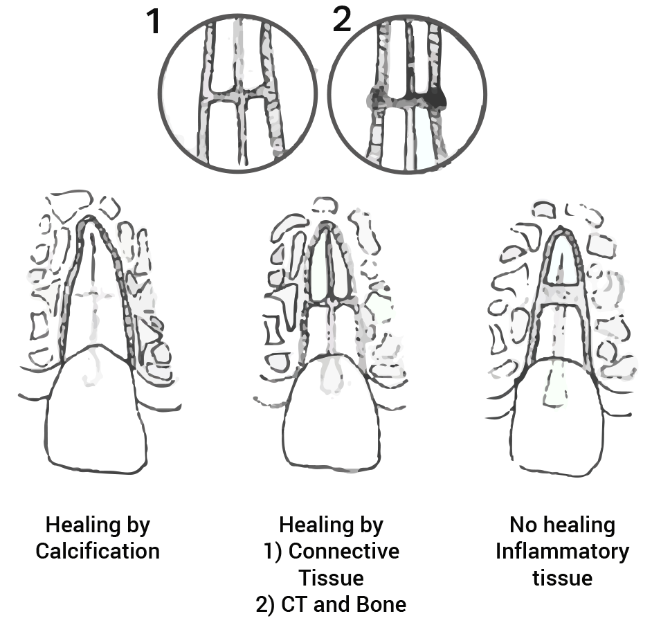 Types of Root Fracture Healing