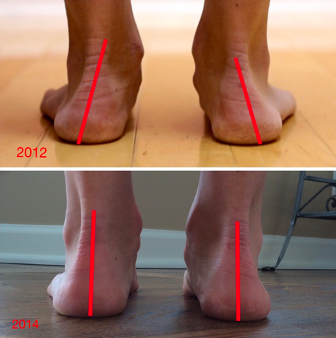 Participant ankle alignment while wearing zetro drop shoes improved ankle strengh